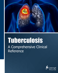 Tuberculosis: A Comprehensive Clinical Reference