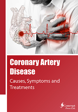 Coronary Artery Disease: Causes, Symptoms and Treatments